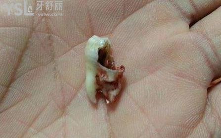 爛牙根很臭要拔掉嗎？