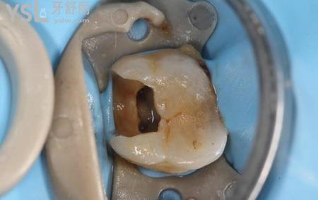 拔牙神經(jīng)痛不痛？有什么危害？