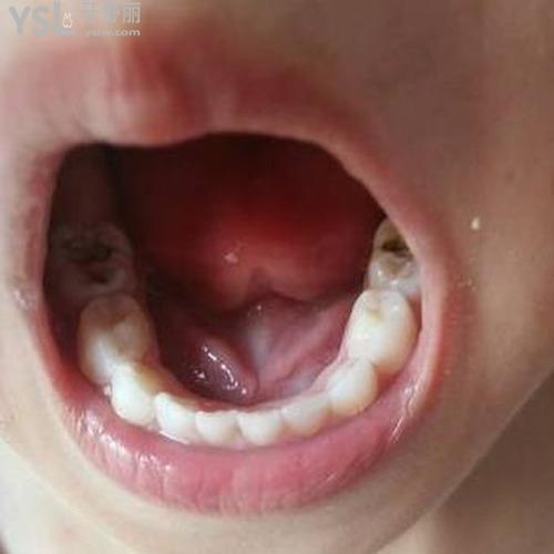 治療蛀牙的方法和步驟有什么注意的？