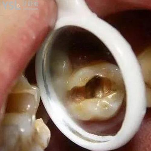 牙神經(jīng)抽掉了為什么還會(huì)疼？