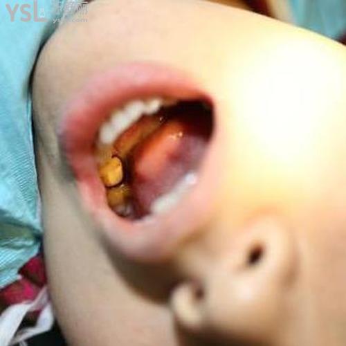 拔牙后頭暈無力是怎么回事？