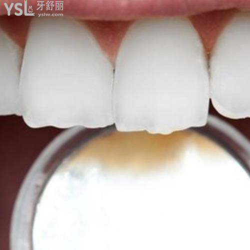 門牙可以補嗎掉了一點？