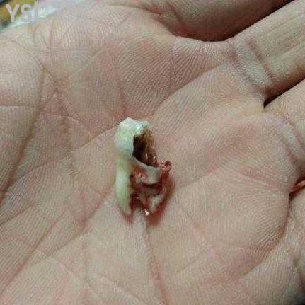 智齒蛀牙了補好還是拔掉好？