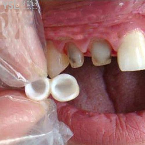 陶瓷牙套和鋼牙套哪個好？