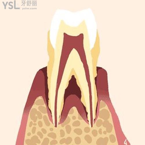 牙齒松動3度需要拔掉嗎？