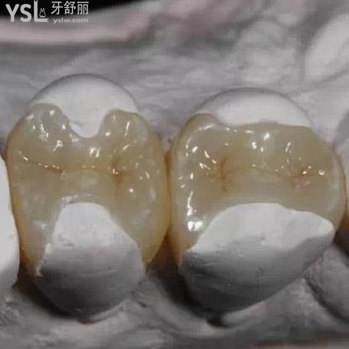 補牙材料哪種好？