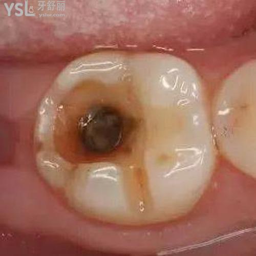 牙壞了怎么補救？