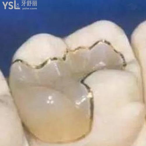 掉了一顆牙補牙怎么補？