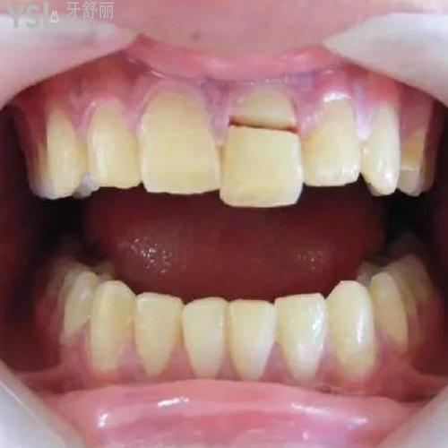 牙齒掉了一塊怎么處理？