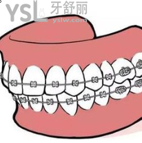 20歲的年輕人做牙套要做什么的？求解答