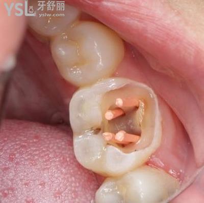 牙齒根管治療是什么意思？