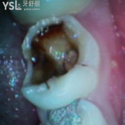 牙齒神經(jīng)壞死了怎么辦？牙神經(jīng)壞死的癥狀是什么？
