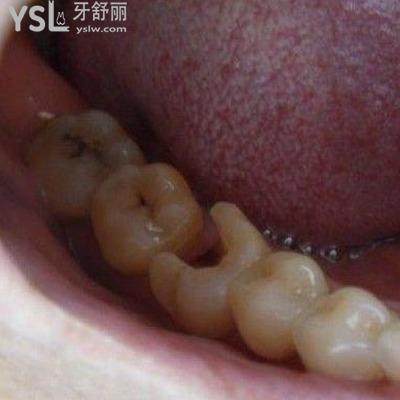 拔牙后根尖炎會消除嗎？根尖炎要怎么治療？