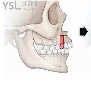 正頜手術(shù)前可以不正畸嗎 能直接做手術(shù)嗎