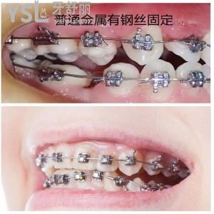 帶牙套期間牙酸是代表牙齒一直在移動嗎？