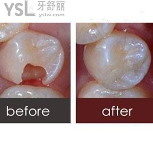玻璃水門汀是什么材料 補牙好不好？