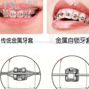 一般托槽牙套是怎么加力的 怎么選擇牙套類型？