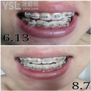 為什么成人不能矯正牙齒？