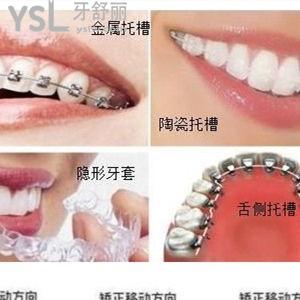 金屬自鎖牙套三萬元貴不貴？