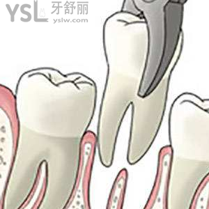 兒童乳牙松動后能不能拔掉？