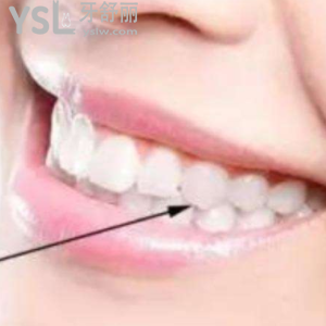 自然標準的牙齒咬合側(cè)面是什么樣的？