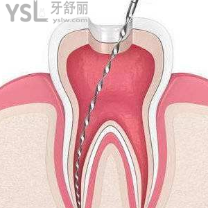 做根管治療要去幾次牙科醫(yī)院？