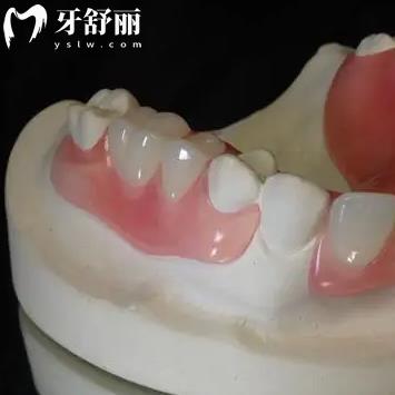 隱形義齒修復