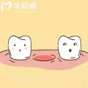 70歲老人適合種牙還是鑲牙？