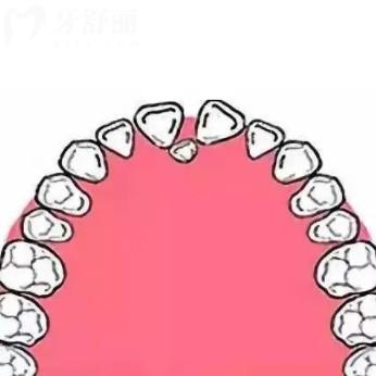 成人多生牙拔除有什么風(fēng)險(xiǎn)嗎？