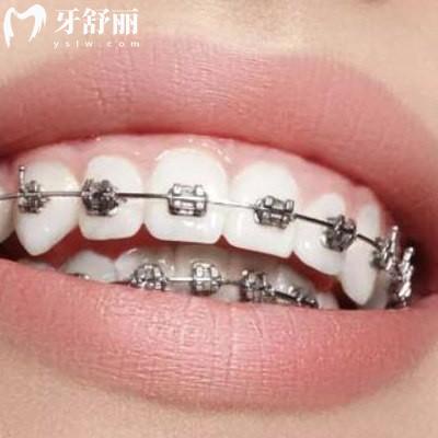 告知曲靖正規(guī)口腔醫(yī)院收費標(biāo)準(zhǔn)是怎樣的，價目表更新包含舌側(cè)隱形矯正等項目