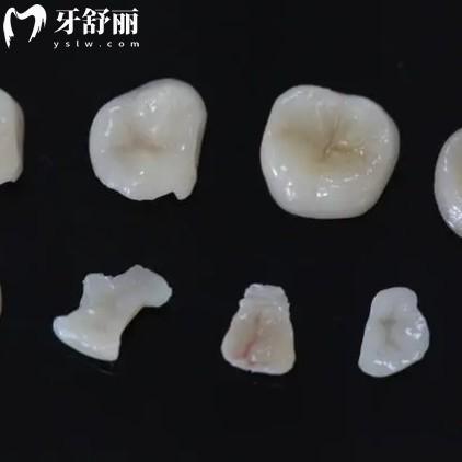 嵌體有哪些材質(zhì)？哪種比較好？