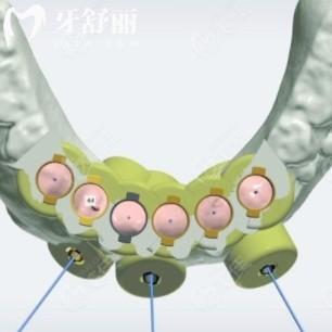 數(shù)字化種植牙和傳統(tǒng)種植牙哪個(gè)貴？