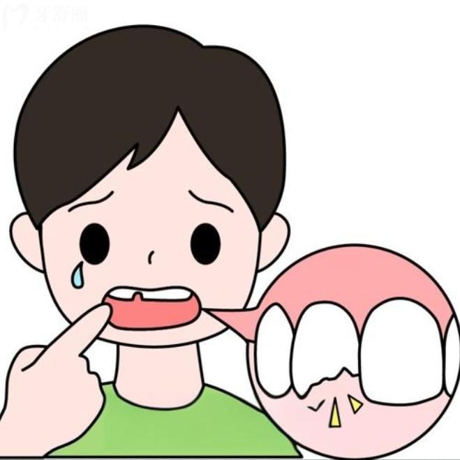 乳牙磕斷了一半怎么辦？直接拔掉還是修復(fù)？