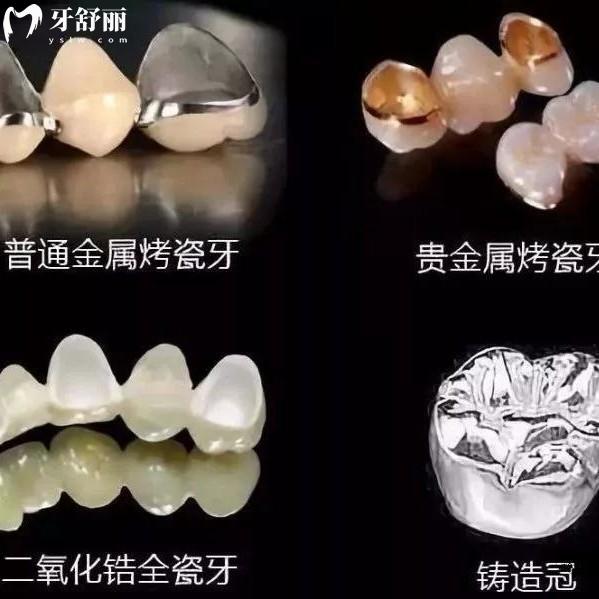 愛(ài)爾創(chuàng)全瓷牙冠質(zhì)保幾年？