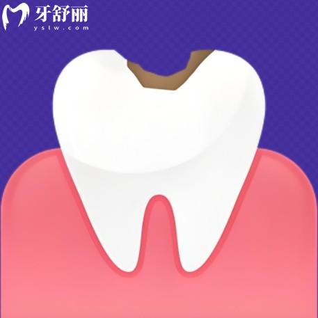 25年寧波補(bǔ)牙多少錢一顆牙價(jià)格表，普通樹脂120+嵌體900+