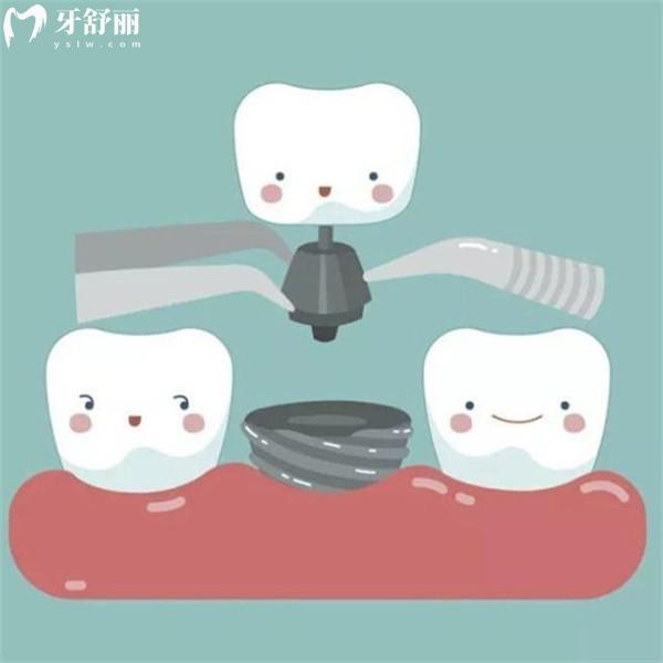 嘉興口腔醫(yī)院種植牙價(jià)格是多少？2025年新收費(fèi)標(biāo)準(zhǔn)及技術(shù)好的種植牙醫(yī)院大公開