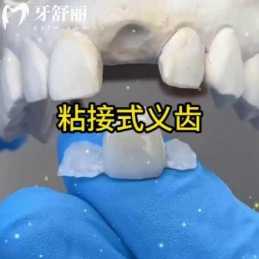 粘接橋修復(fù)優(yōu)缺點分析：不磨牙的補牙法，真香還是踩坑？