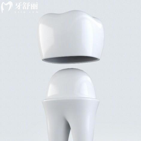 ??德國(guó)牙冠哪家強(qiáng)？威蘭德/澤康/西諾德六大品牌價(jià)格、特點(diǎn)一篇看懂！?